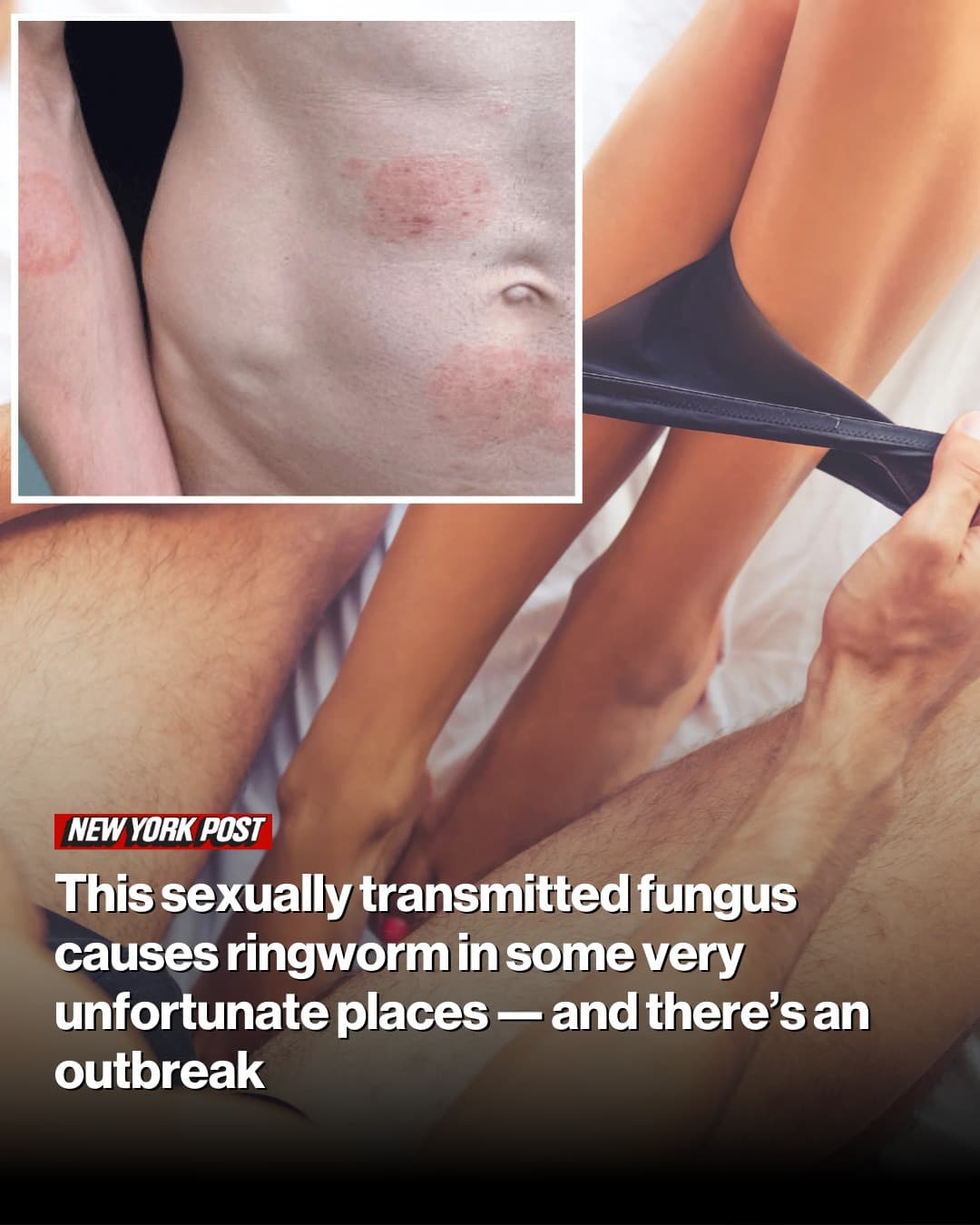 New STI Outbreak Linked to Ringworm in Intimate Areas